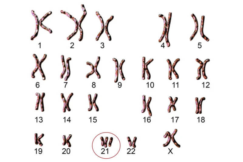 Benh-down-Trisomy-21